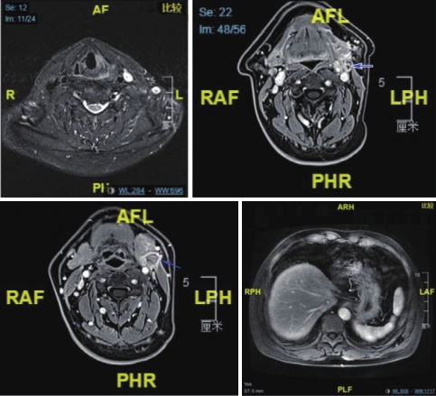 图3 喉MRI及腹部MRI（4疗程后）.jpg